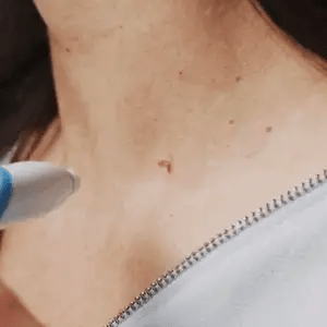 Kit quitamarcas cutáneas suave Aero Tag — sistema doméstico de 6 etapas