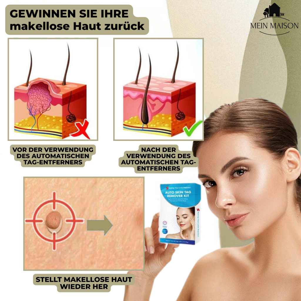 מסיר יבלות DermaLinx — טיפול מקומי ללא כאב לעור חלק יותר