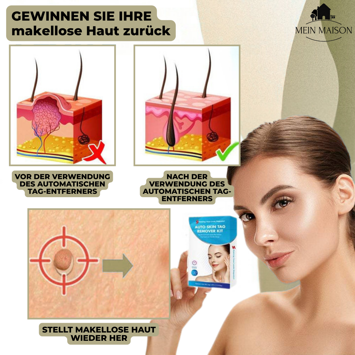 מסיר יבלות DermaLinx — טיפול מקומי ללא כאב לעור חלק יותר