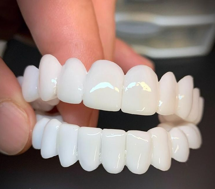 Indywidualnie dopasowane nakładki dentystyczne Smile Restore — naturalny wygląd, zdejmowana alternatywa dla brakującego zęba