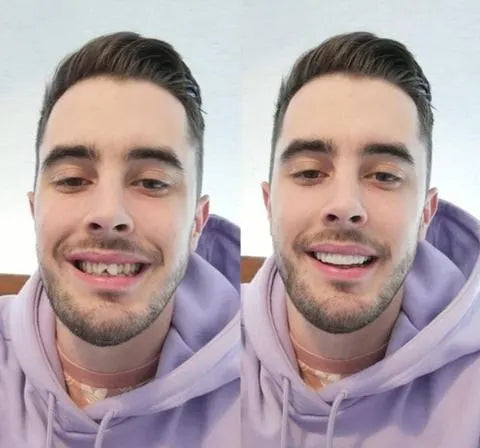 Smile Transformation snímatelné fazety – lehké odnímatelné zubní kryty
