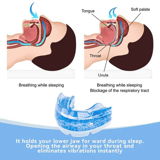 Adjustable Snore-Reduction Mouthpiece For Improved Airflow