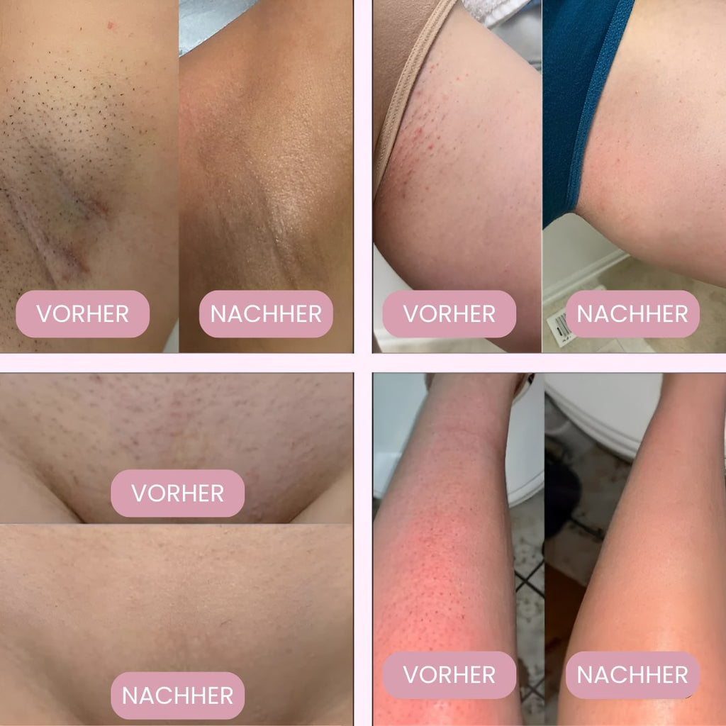 ماكينة حلاقة كهربائية للمناطق الحساسة للنساء Femora — أداة تشذيب لمنطقة البيكيني لإزالة الشعر بلطف وراحة