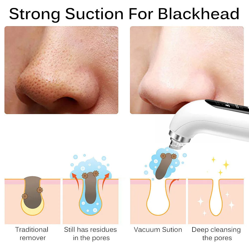 Facial Pore Cleanser Vacuum - Gentle Blackhead Extraction Tool | Ka-mostore