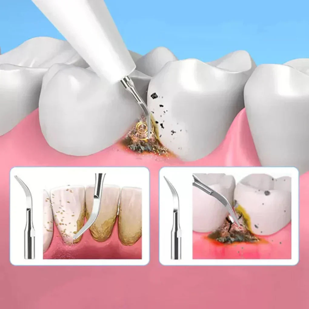 Ultrasonic Dental Scaler for Plaque & Tartar Removal | Ka-mostore