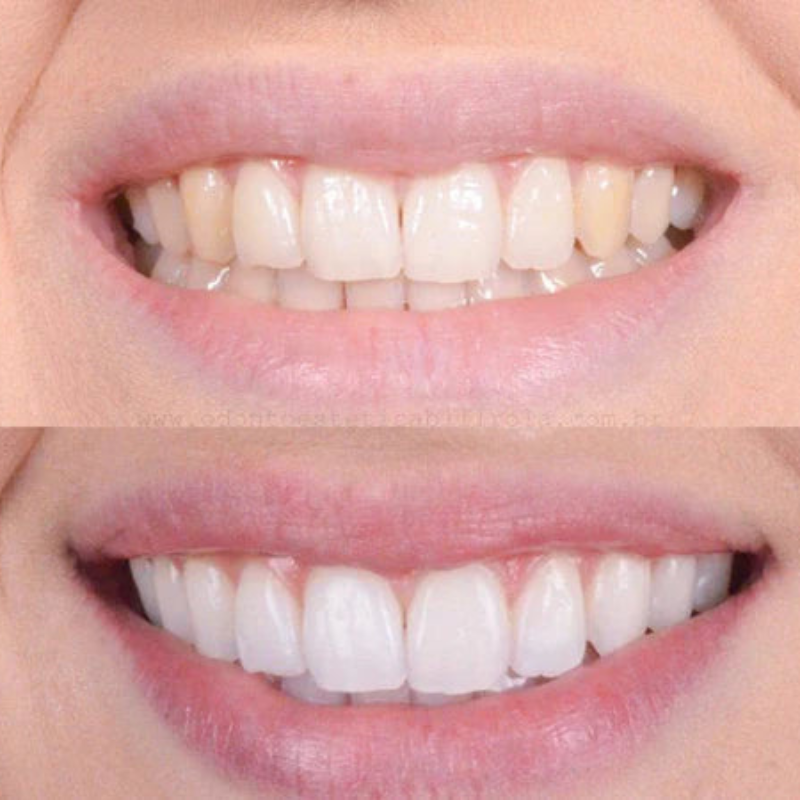 Quick Teeth Whitening for a Radiant Smile | Ka-mostore