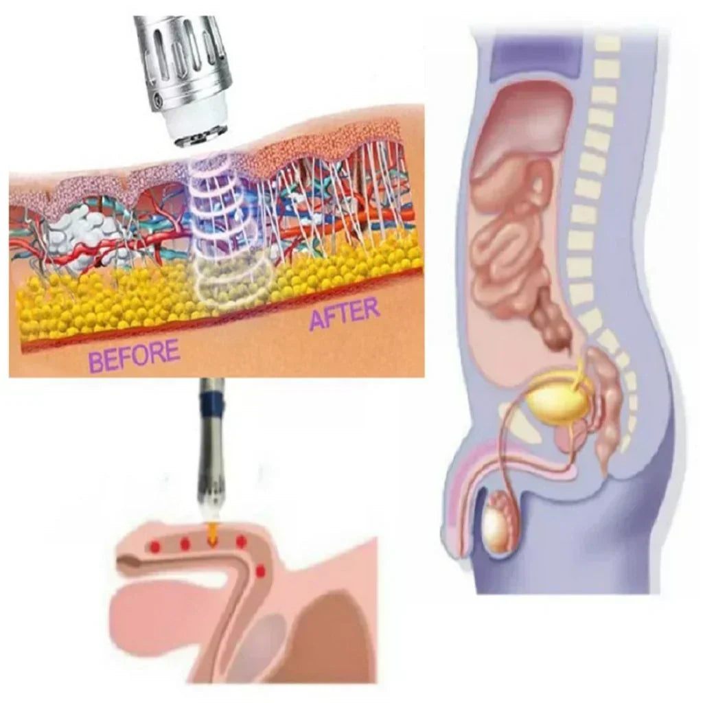 VitaPulse Portable ED Shockwave Therapy Device for Men | Ka-mostore